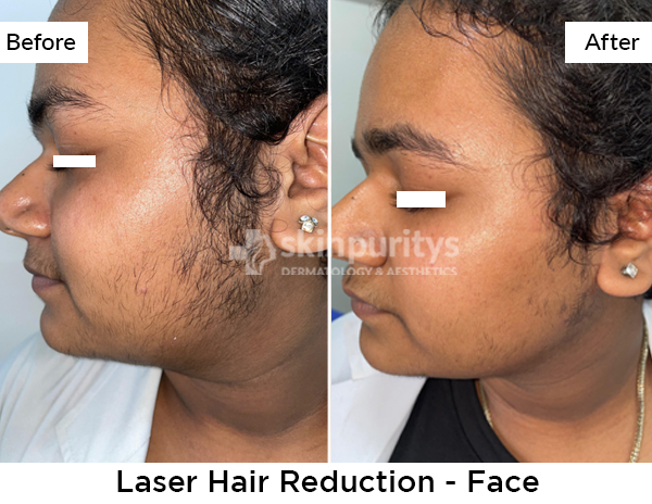 Facial Hair Removal results
